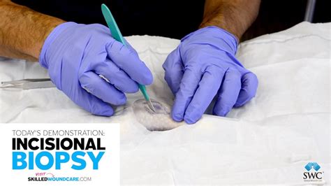 Incisional Biopsy Demo - Skilled Wound Care - YouTube