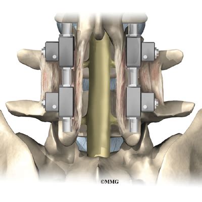 Lumbar Spondylolisthesis | Orthogate