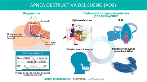 Tratamiento de la Apnea obstructiva del sueño (AOS)