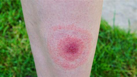 What Does a Tick Bite Look Like? - Health