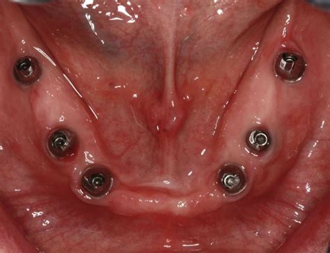 How Many Implants in the Edentulous Mandible? - Spear Education