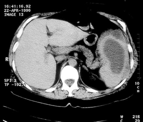 Abscesses of the spleen: Report of three cases