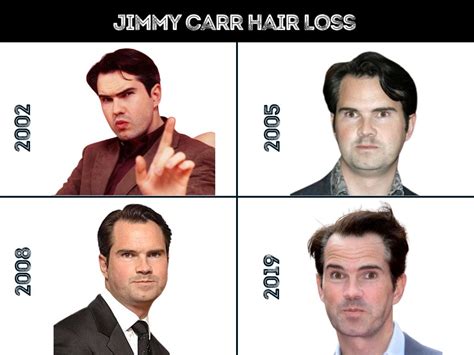 Jimmy Carr Hair Transplant - Hair Loss & Technical Analysis