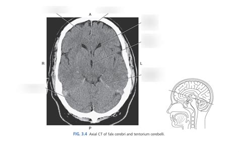 Diagram of Axial CT of Falx Cerebri & Tentorium Cerebelli | Quizlet