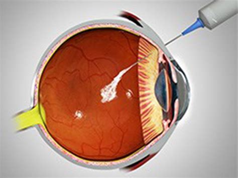 Intra vitreal injection for Eye problems Kochi - Dr Tony Fernandez Eye ...