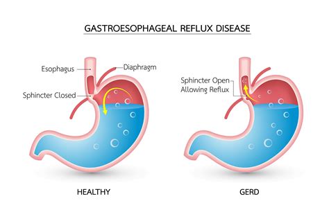 How To Treat Cough From Gerd ~ Gastric Reflux Treatment