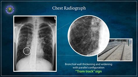 Bronchiectasis - causes and diagnosis