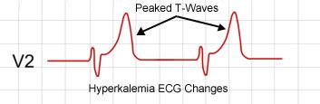 A Guide To Hyperkalemia - Stepwards