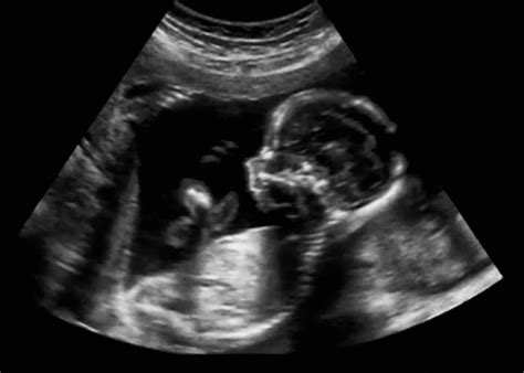 An OB-GYN Explains the Difference Between Sonograms & Ultrasounds ...