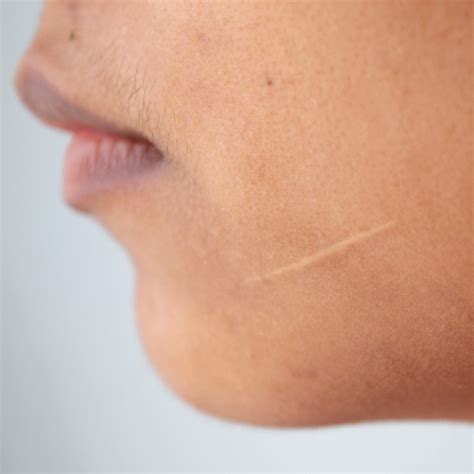 Scar Revision | Scar Care | Scar Treatment | Plastic Surgery | Plastic ...