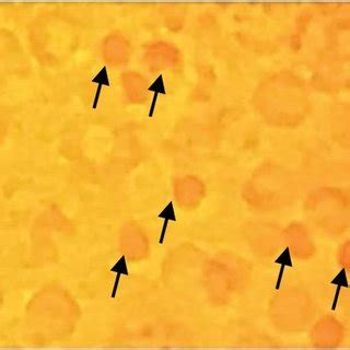 Phase contrast microscope images of the husbands' peripheral blood ...