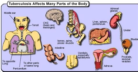 Some Causes of TB Disease | Health and Beauty Care