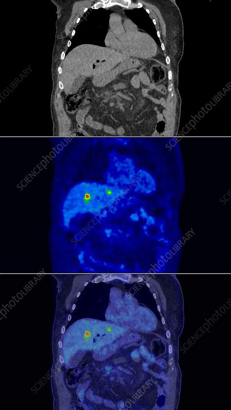 Secondary liver cancer, CT and PET scan - Stock Image - C052/2515 - Science Photo Library