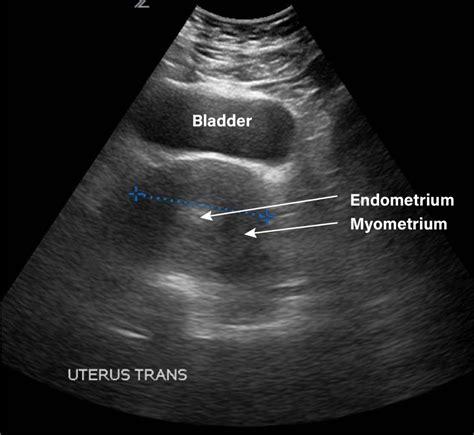 Gynecology Pelvic Ultrasound Made Easy Step By Step Guide Gynecology | Hot Sex Picture