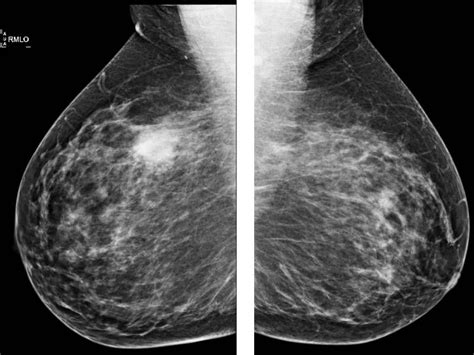 Radiology, Rio, Breast, Pictures