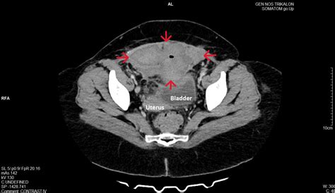 Surgical Treatment of a Large Post-cesarean Hematoma in the Retzius ...