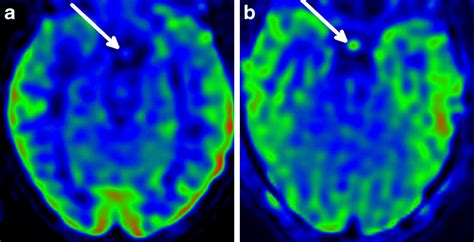 The pituitary stalk is marked by arrowheads. a Axial arterial spin ...