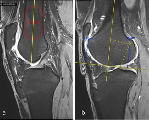 The lateral condylar index: two circles are drawn in a sagittal MRI... | Download Scientific Diagram