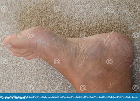 Sore Cracked Dry Skin on Feet Dry Dehydrated Feet of a Lady Stock Image - Image of feet, lady ...