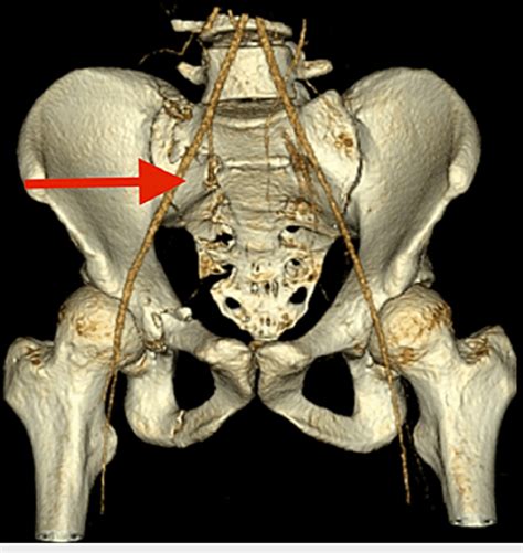 CT scan of the second patient showing right sacral ala fracture with... | Download Scientific ...