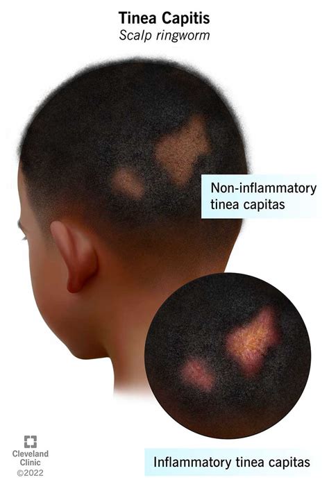 Tinea Capitis: Symptoms, Causes & Treatment