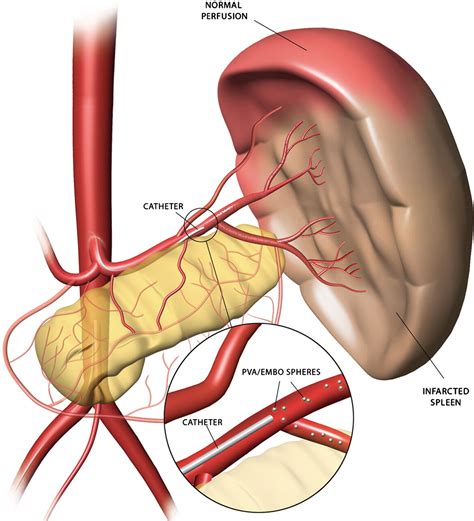 Splenic Arterial Interventions: Anatomy, Indications, Technical ...