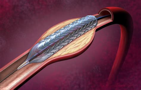 Balloon Stent Angioplasty Illustration by Scott Leighton | Medical Illustration & Animation