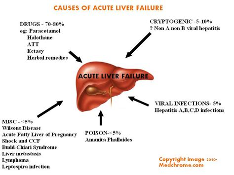 Acute Liver failure: Classification, causes, features and management ...