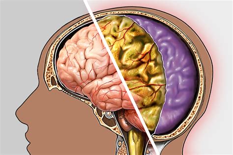 Meningitis Diagnosis and Treatment in Thailand - Almurshidi Medical ...