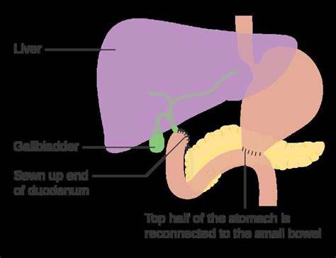 Billroth 2 Anatomy