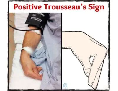 Trousseau's Sign |Causes |Assessment |Treatment - Nurseship.com