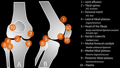 Schematic representation of the knee (frontal view in A, lateral view... | Download Scientific ...