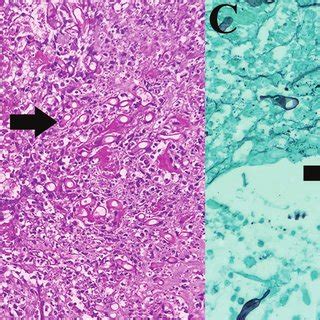 1 Microscopic morphology of Mucorales in tissue section stained with ...