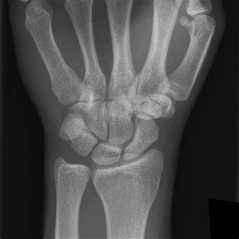 EMRad: Radiologic Approach to the Traumatic Wrist