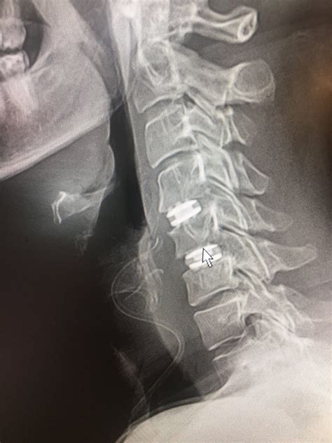 Cervical Artificial Disc Replacement (ADR) Vs. Anterior Cervical ...