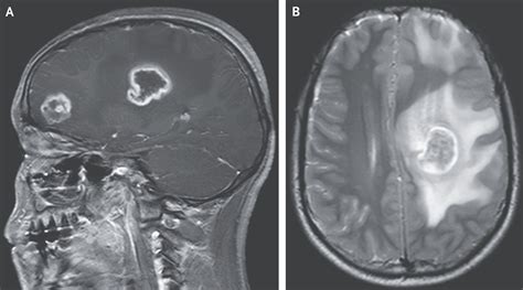 Boy's Brain Started to Rot After Rare Parasitic Infection - Newsweek