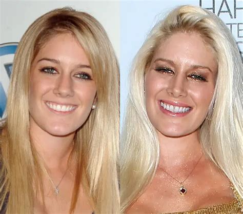 Heidi Montag Nose Job Plastic Surgery Before and After | Celebie