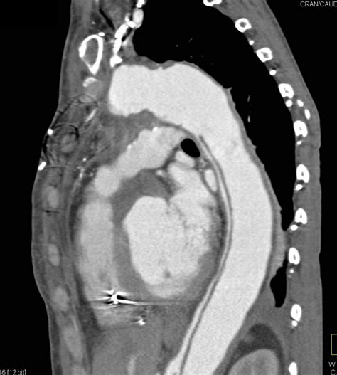 Aortic Dissection with Repair of Ascending Aorta with Dissection in ...