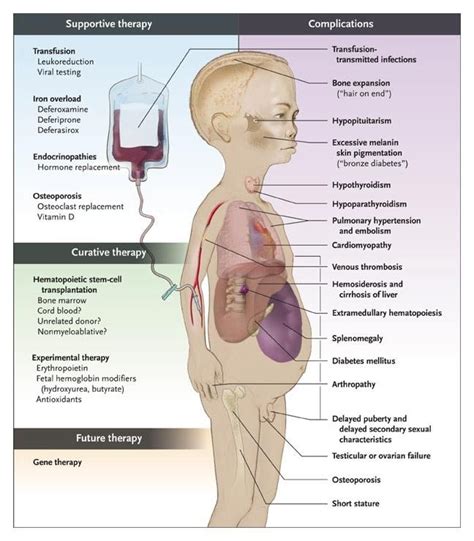 Image result for thalassemia effect on the body | Pediatric nursing, Nursing notes, Nursing study