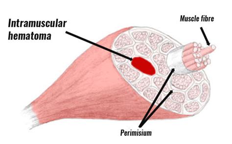 Calf Contusion - Symptoms, Causes, Treatment & Rehabiltiation