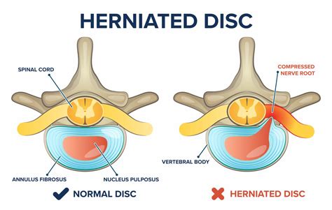 Does stretching help a slipped disc? - Health Blog