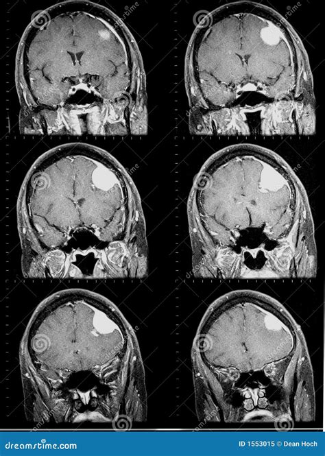 Mri of Brain Showing Brain Tumor Stock Image - Image of diagnostic ...