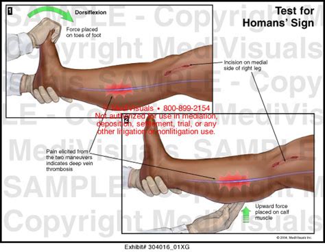 Medivisuals Test for Homans' Sign Medical Illustration