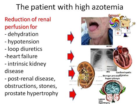 Azotemia: Types, Causes, Symptoms Treatment, 56% OFF