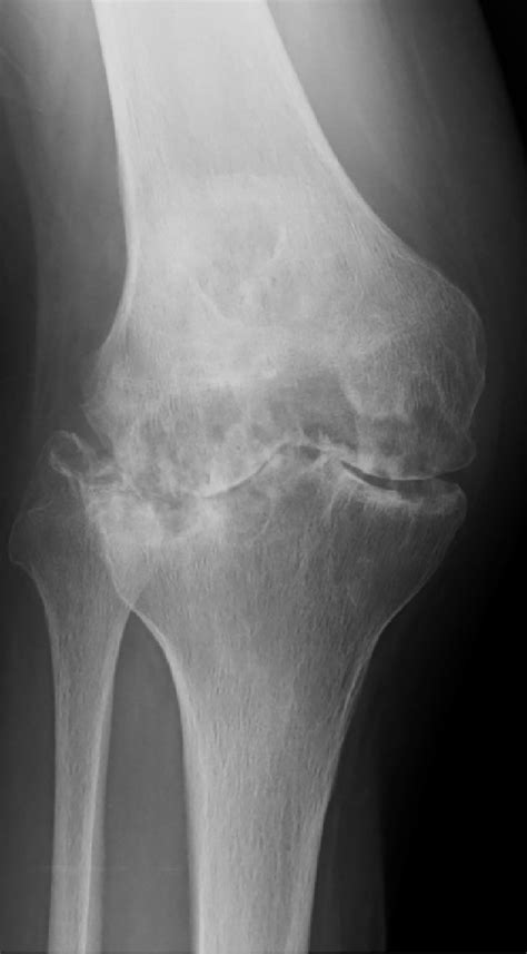 Long-term outcomes in TKA patients with rheumatoid arthritis