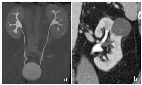 Medicina | Free Full-Text | CT Urography Findings of Upper Urinary ...