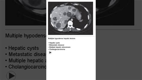 Differential diagnosis of Multiple hypodense hepatic lesions #shorts ...