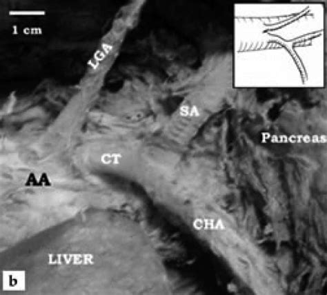 showing the branching pattern of the celiac trunk; (a) a gastrosplenic... | Download Scientific ...