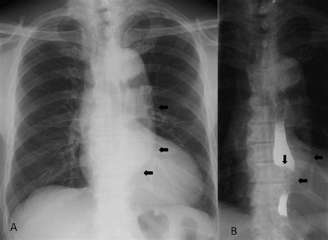 Chest X Ray Tortuous Aorta