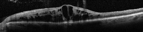 Figure 2. OCT of an acute CRVO with severe macular edema. Image courtesy of John Thompson, MD ...